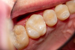 dental sealants last