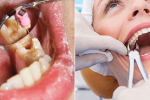 choose root canal or tooth extraction