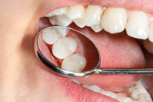 dental sealants checked by dentist