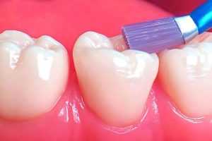 disadvantages of dental sealants