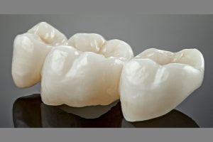 fix a loose dental bridge at home safely and effectively