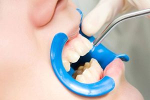 what are dental sealants made of and are they safe
