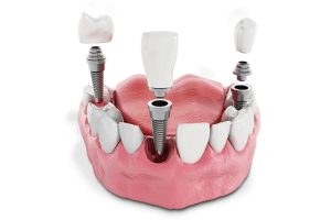 what is full arch dental implant