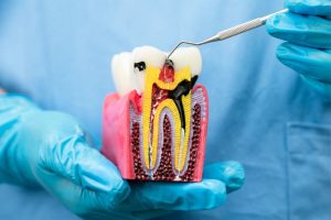 why abscess may persist after root canal treatment