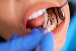 how long can leave cavity untreated