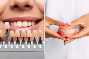 veneers or dentures what is difference and which best