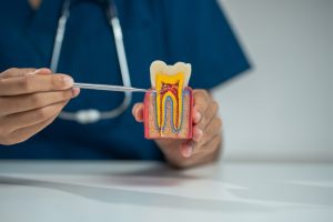 why would someone need root canal