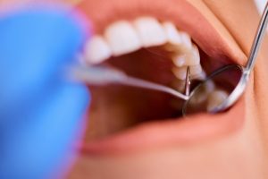 dental filling dentistry