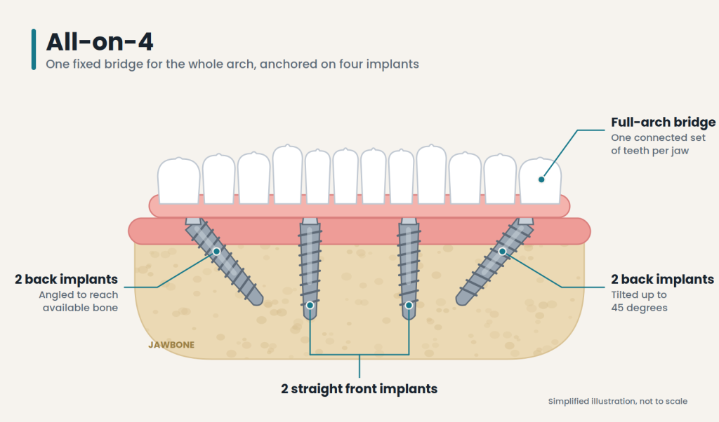 all on 4 dental implants diagram