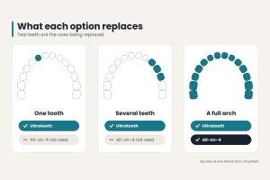 all on 4 vs ultrathooth dental implants