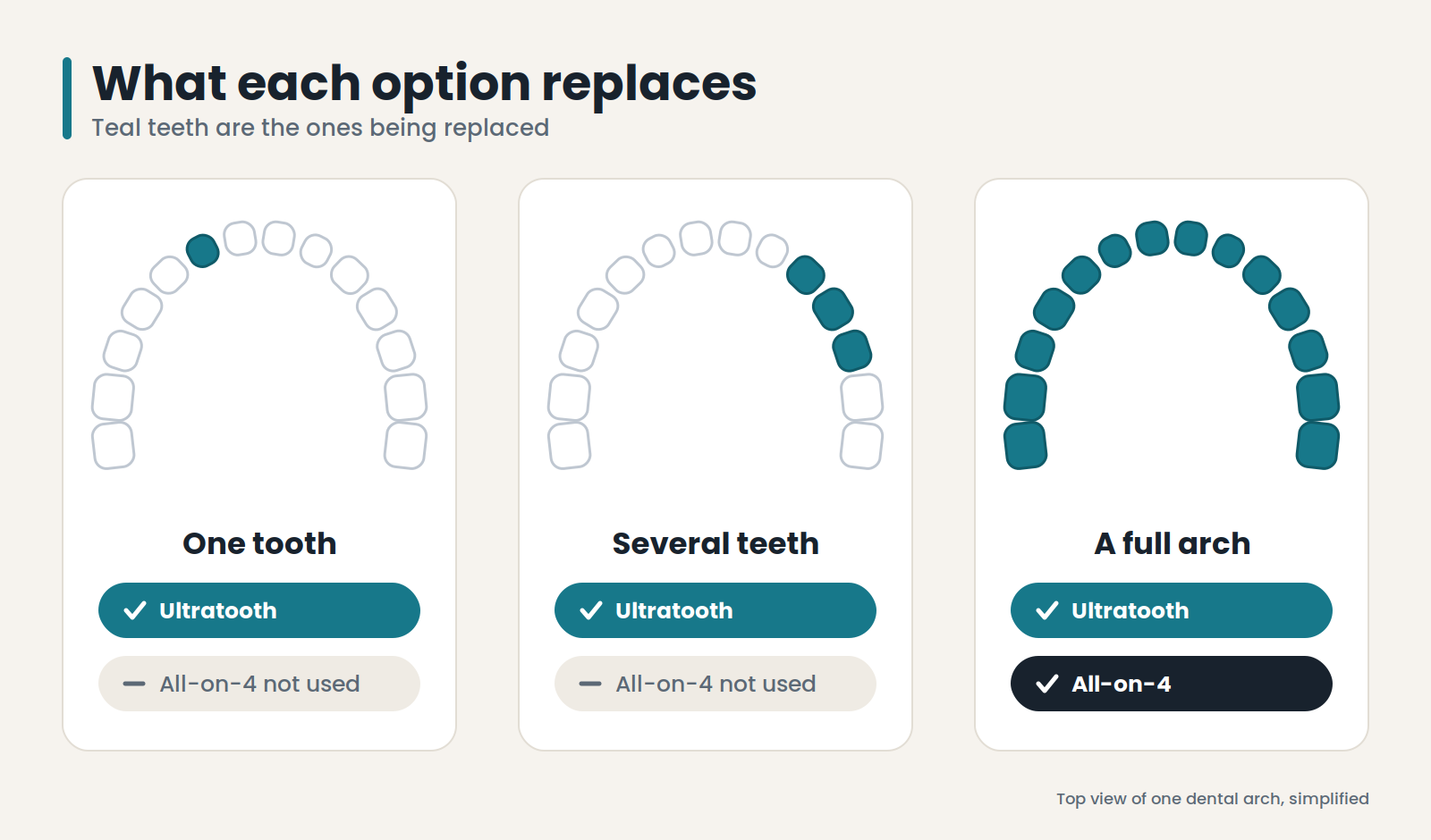 Comparison of what All-on-4 and Ultratooth replace, showing one tooth, several teeth, and a full arch