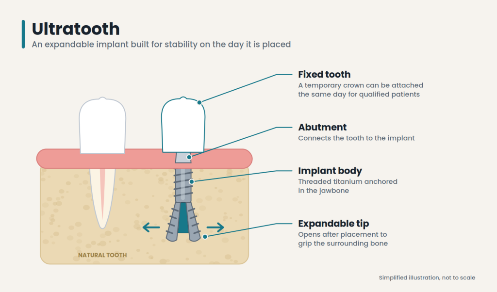 ultratooth expandable dental implant diagram